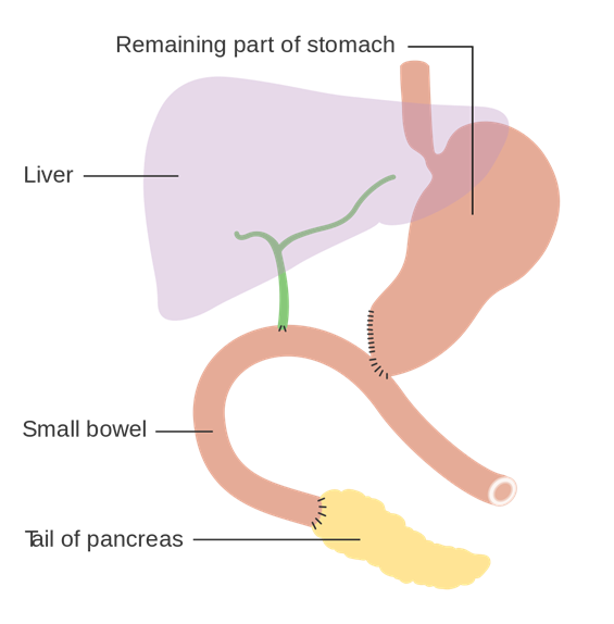 Diagram Showing How The Pancreas And Bowel Is Joined Back Together After A Whipples Operation CRUK 140Svg