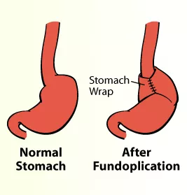 Gastroesophageal Reflux Disease (Pediatric) | UCSF Department of Surgery